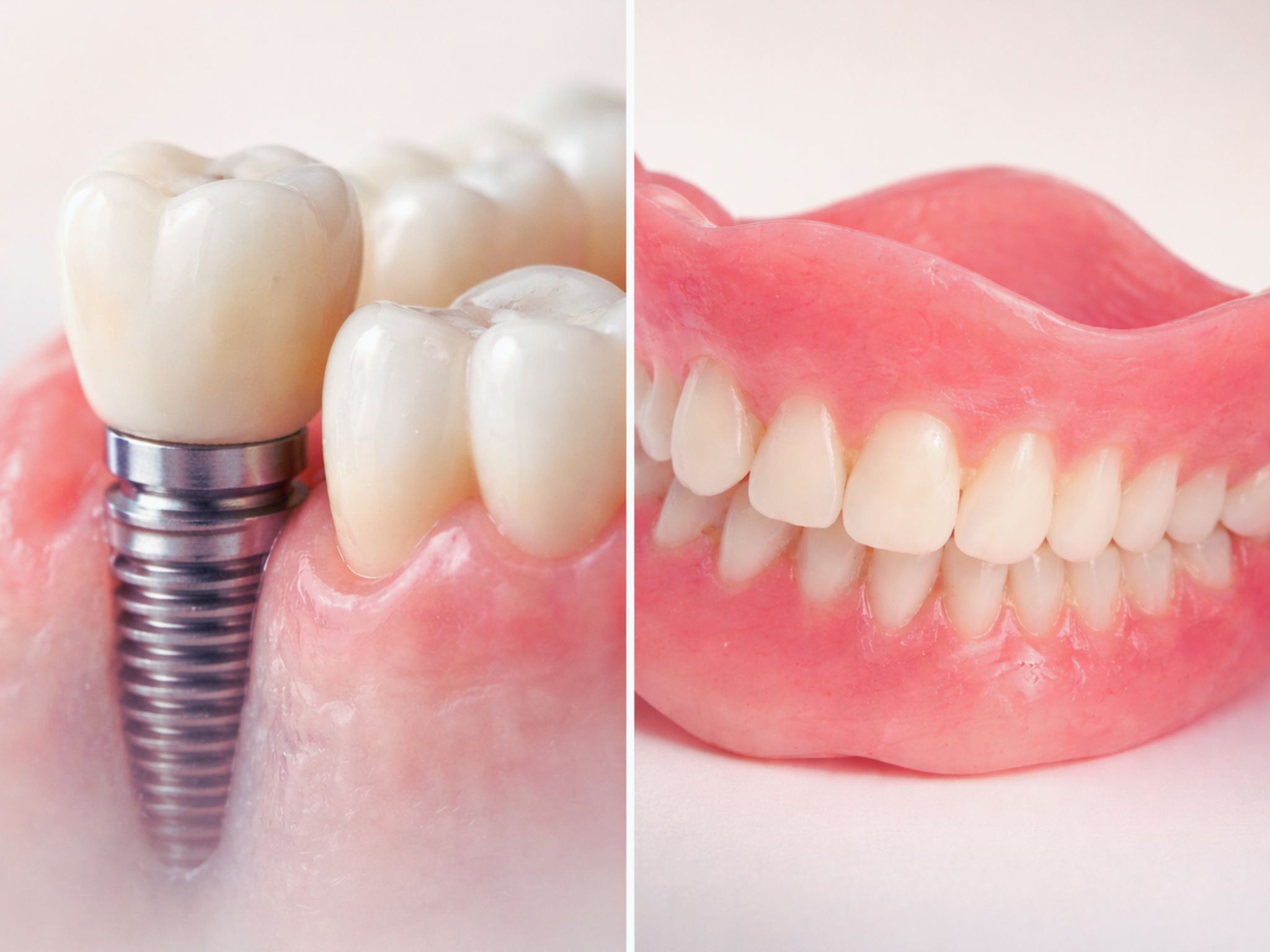 considerations between implant or dental