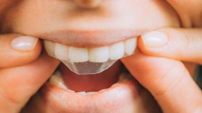 Over-the-counter whitening strips — risks compared to professional teeth whitening