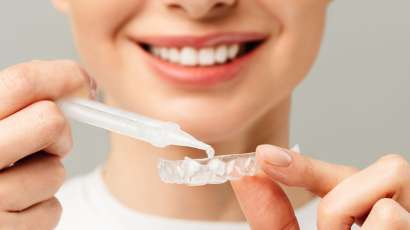 Take-home teeth whitening custom trays from Dentalis Singapore