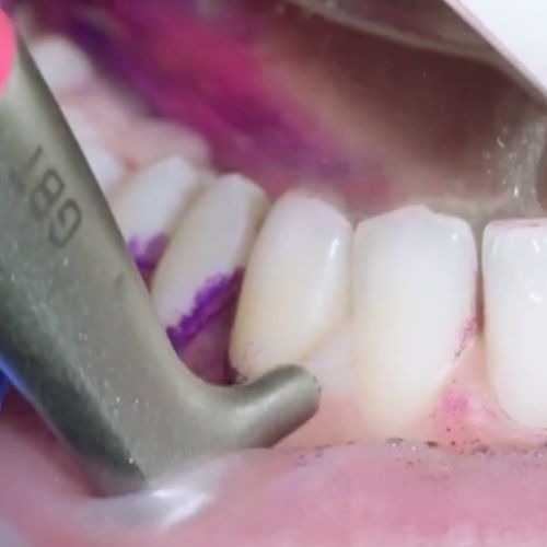Who is Guided Biofilm Therapy GBT ideal for — Dentalis Singapore CBD