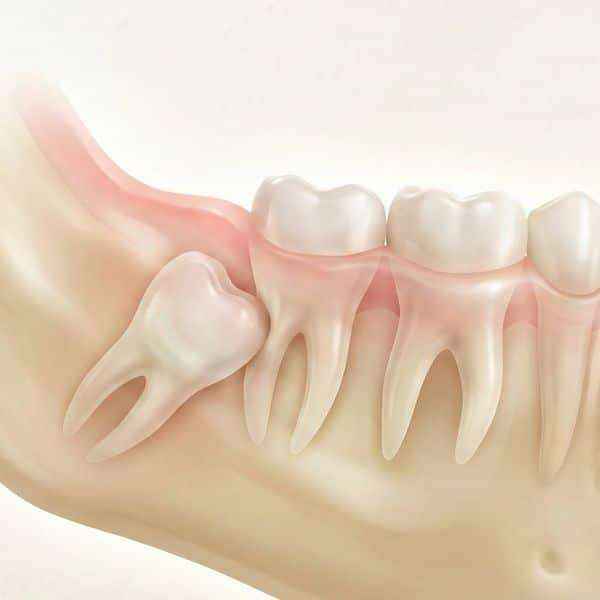Impacted wisdom tooth requiring surgical removal at Dentalis Singapore